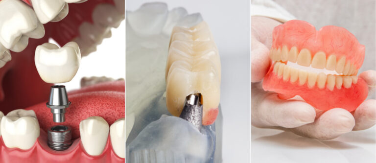 types of dental implants
